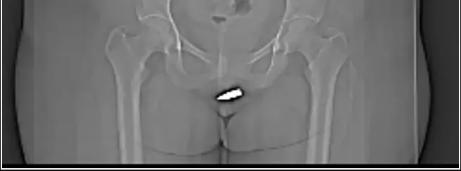 24歲女子在家休息「一顆東西穿進來」　就醫驚見子彈「卡到陰」...真相太嚇人