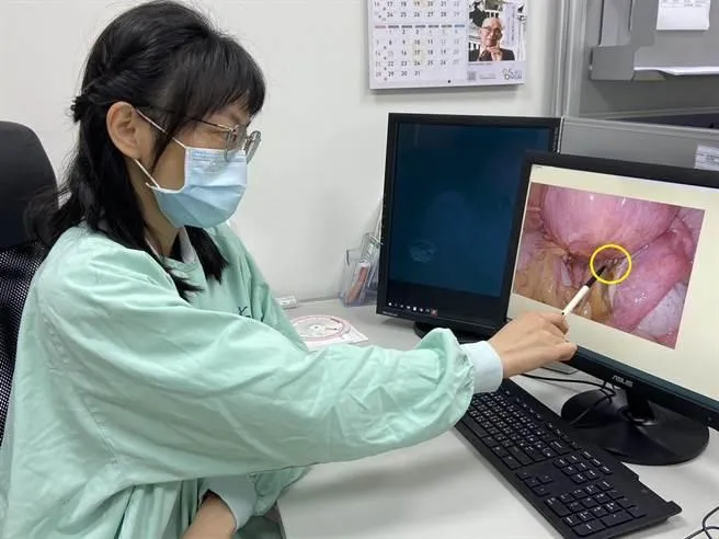 巧克力囊腫可能癌變！「這些人」是高危族群