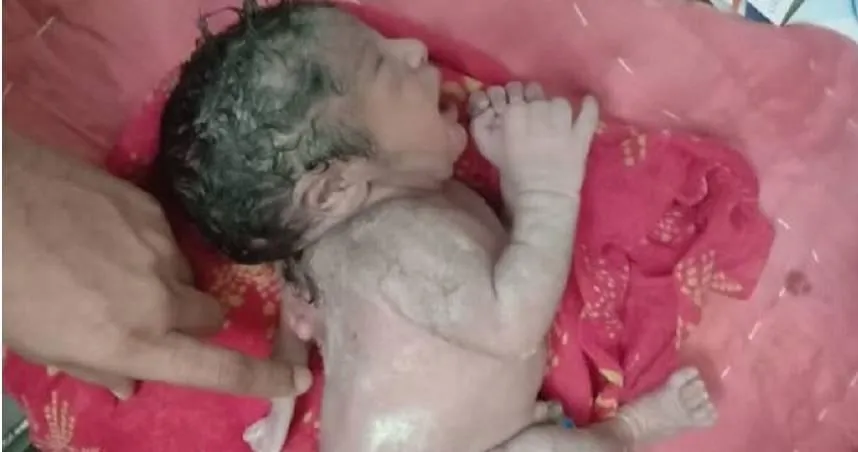 印度嬰出生患罕病背部竟長「第3隻手」！醫揭：如何形成