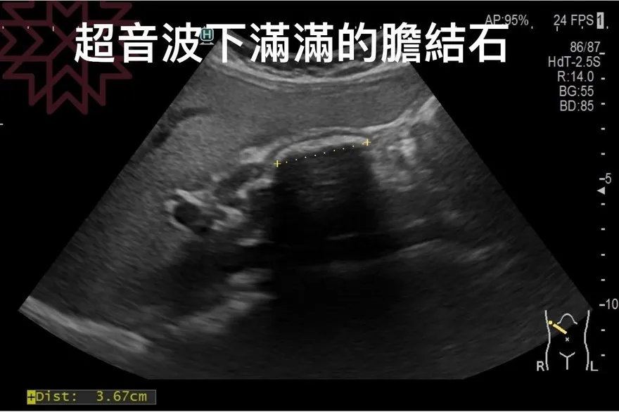 我的天啊！314顆膽結石藏體內　醫籲尿液變色要注意