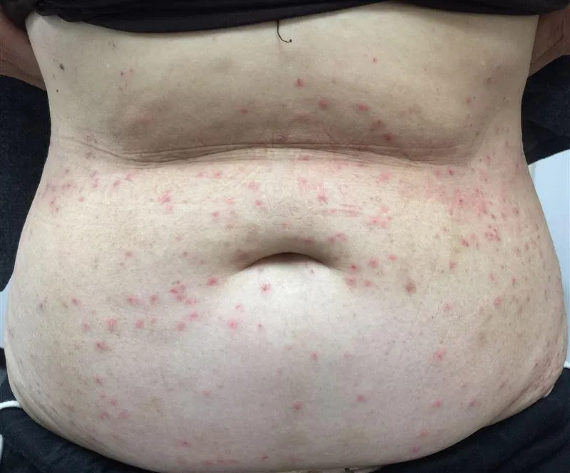 無過敏史！她染疫1個月後「爆長紅疹」半夜狂癢醒　竟也是長新冠