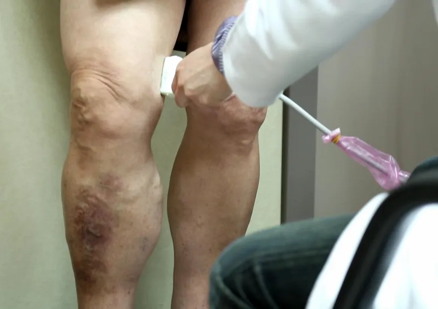 台灣靜脈曲張就醫率不到1%！別小看靜脈曲張　不醫治恐血栓