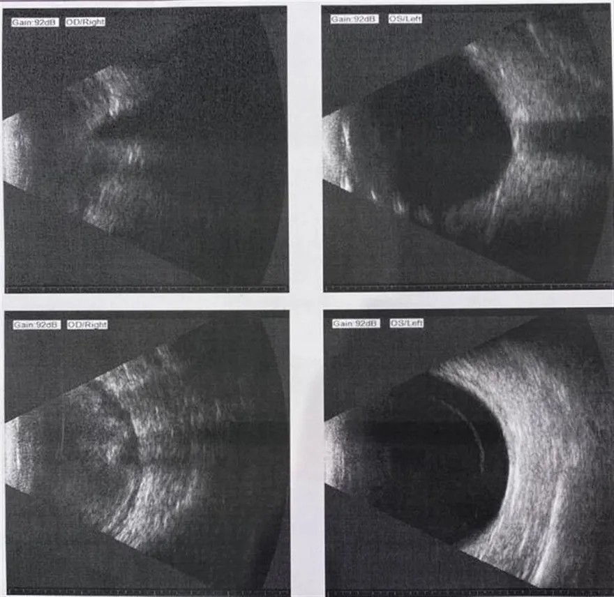 七旬嬤「細菌竄頭」右眼球如大膿包　被迫摘除竟然是吃了「野豬肉」