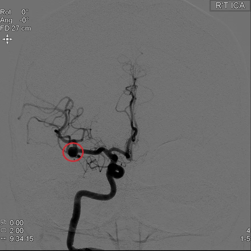 頭暈不當一回事！6旬婦暈2年　檢查驚見2顆腦內動脈瘤