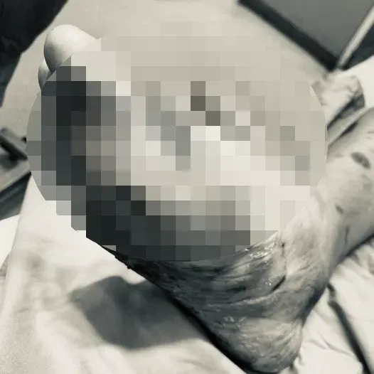 有圖慎入！男拇指發黑竟用利器「整根剪斷」腐肉味飄急診　醫一看超心疼