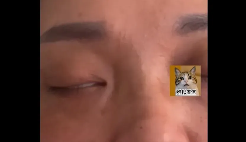 影/一洗臉就進水！花1.3萬割眼袋致「無法閉眼」　她崩潰：難受到想摳眼珠