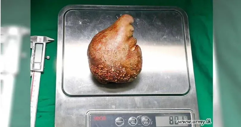 竟破金氏世界紀錄！62歲老兵切除「超大腎結石」重達801克