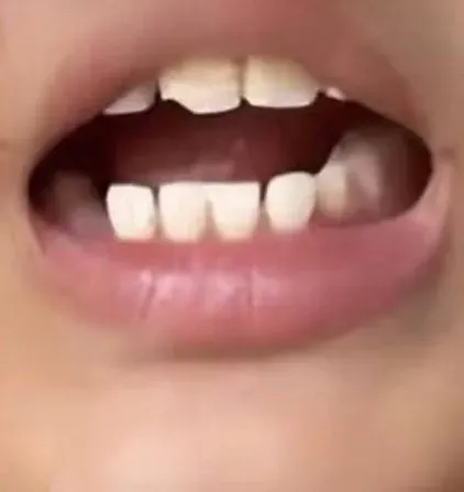 小學生疑遭班導施暴…滿身針眼「門牙缺半顆」　控訴：對方不肯停手