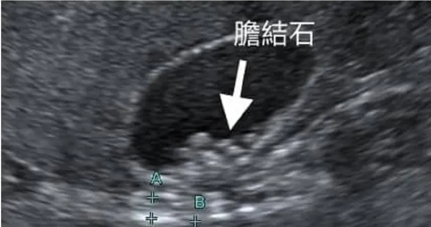 50歲婦女胃脹治不好！竟2年暴長8顆「膽結石」　醫曝「這習慣」釀