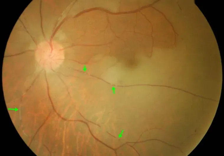 抽菸喝酒30年引「眼中風」差點失明！ 高壓氧治療救視力