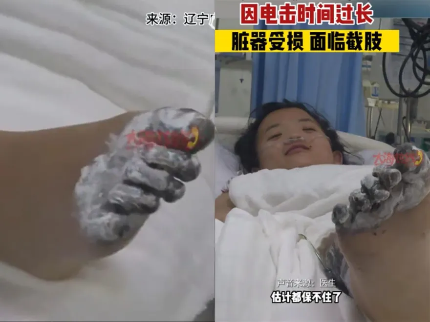 影/邊充電邊玩iPhone…17歲女觸電「腳趾焦黑」需截肢　Apple客服：充電器非原廠不賠