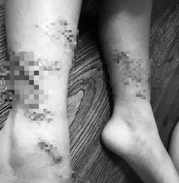 悚！男童到台南海邊戲水「雙腿慘遭割傷濺血」　母怒PO文：浮球繩子割人！