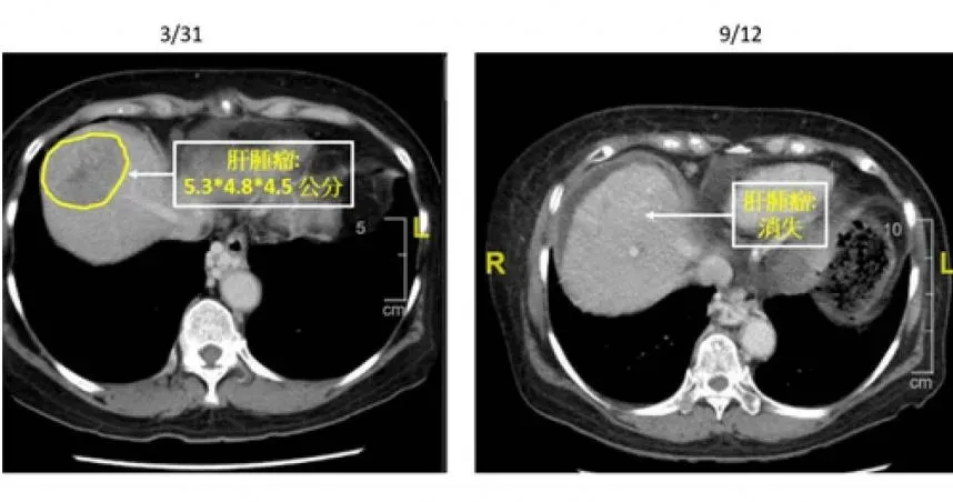 70歲嬤肝臟5cm大腫瘤手術風險高！採「立體放射合併標靶治療」成功消腫瘤