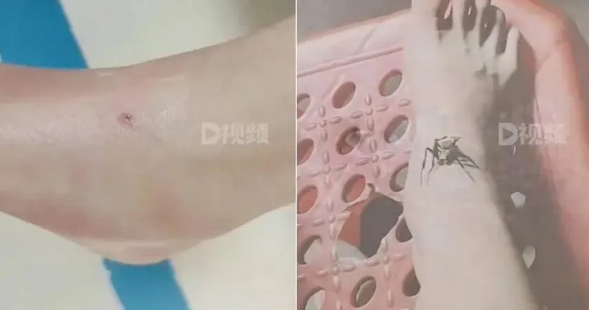 9歲女童被蛇咬傷　奶奶竟放蜘蛛吸毒！「雙倍毒素 」女童結果慘爆