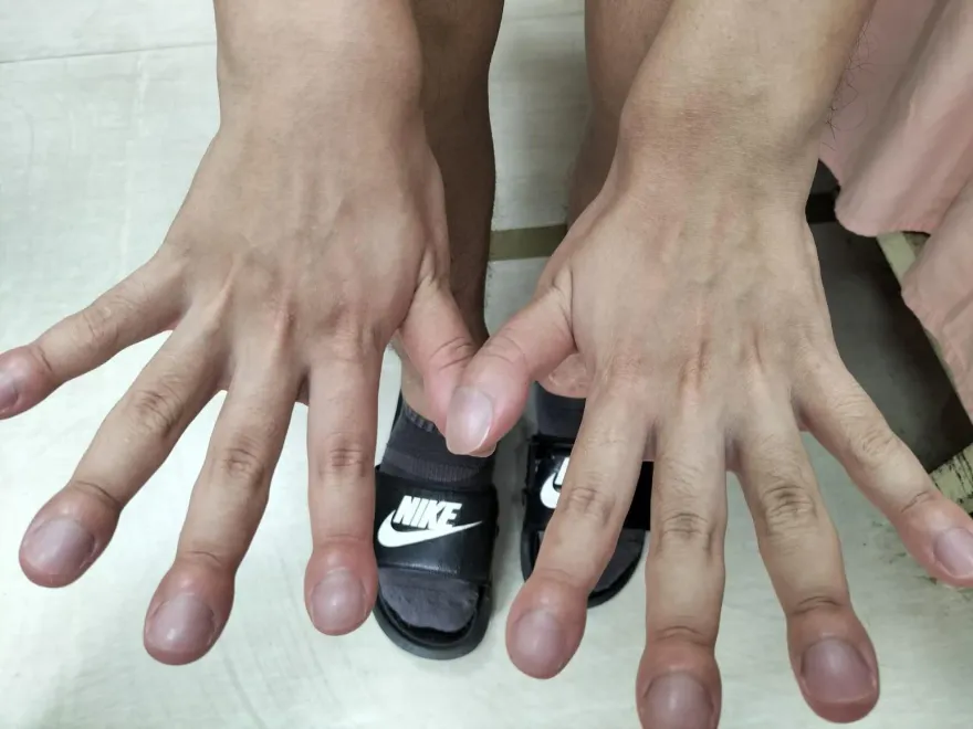 全台不到20例！年輕男子驚見「杵狀指」罕見疾病　醫揭：無法痊癒