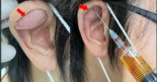 注意！35歲外送員戴安全帽太用力　外耳整個凸出來！醫曝：罕見外耳殼偽囊腫