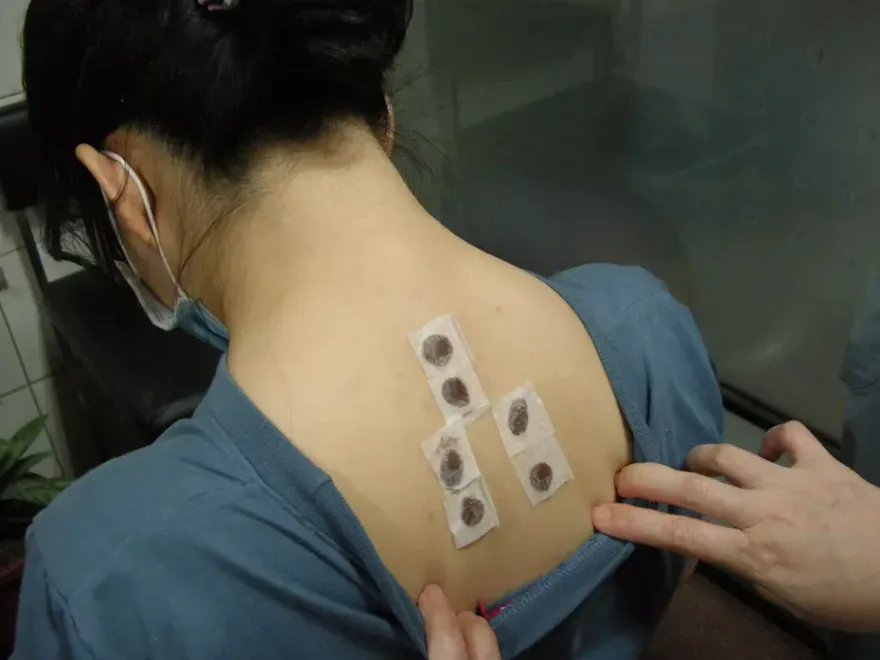 天熱是「三伏貼」治療最佳時機！刺激穴位治過敏　療程前中後留意「這些」反應