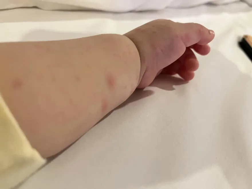 演員李亮瑾二寶疹子、水泡布滿全身！就醫才知患「兒童大魔王」