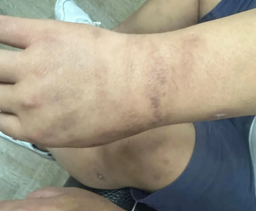 早餐店老闆被騙到柬埔寨加盟淪人囚　驚險逃出！曝火烤傷痕