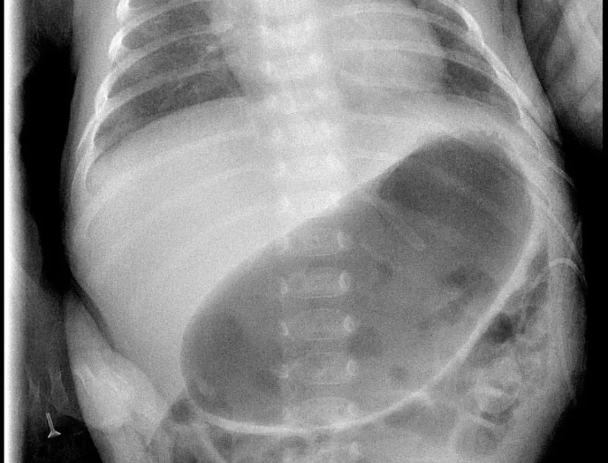 你的孩子常「噴射性」嘔吐？小心是嬰兒肥厚性幽門狹窄