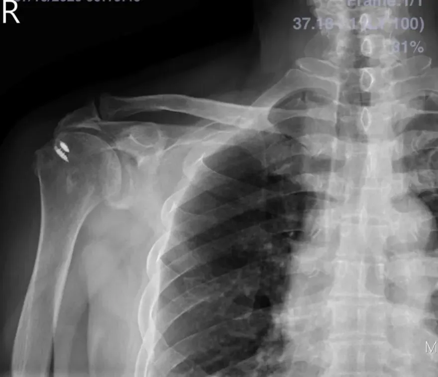 巨大旋轉肌腱破裂新救星！「新型反式全人工肩關節」助67歲伯一覺好眠