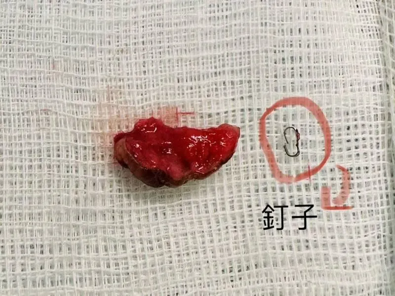 愛愛時小兄弟總是有「腫凸感」？切開一看包皮上竟有「釘子」