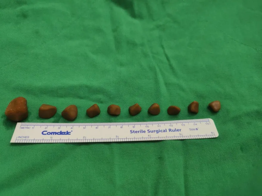70歲老翁攝護腺肥大、泌尿道問題！竟身藏「10顆結石」又多又硬