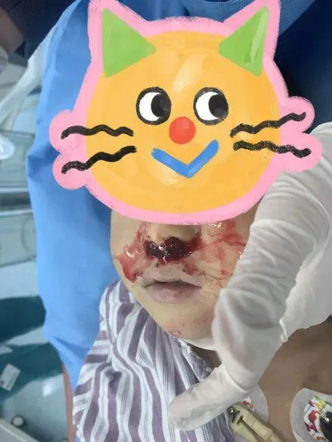 母湯！3歲童流鼻血奶奶往鼻裡塞「頭髮」　血沒止住送醫已休克