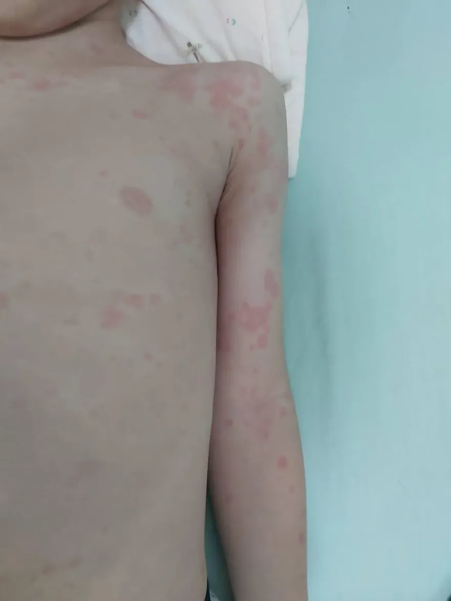 傳染力極高「黴漿菌」！4歲男童紅疹爬滿身　醫抽血驚見「全家都中」