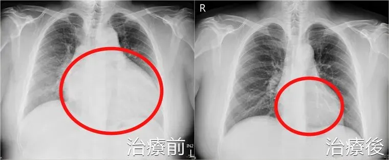 45歲男「爬1層樓就喘」心臟竟超大如籃球！嚴重恐猝死