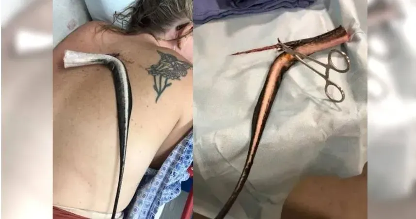 海灘玩水魟魚毒刺竟扎進身體！　美國女爆痛直呼：「我要死了」