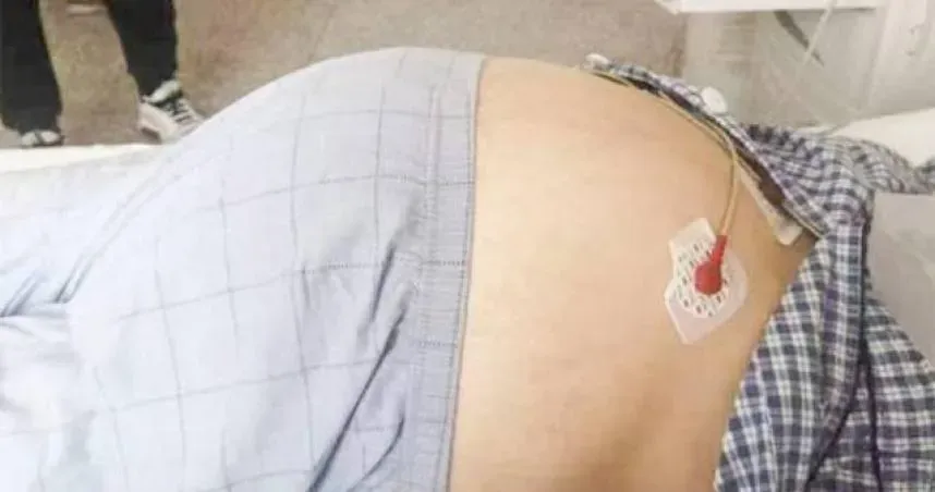 39歲女肚藏16KG超大腫瘤！腸子被壓成「紙片」　醫：比癌還惡