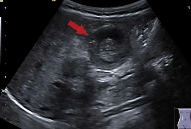 嬰幼兒染「腺病毒」後哭鬧不安！醫示警：「腸套疊」嚴重恐腹膜炎