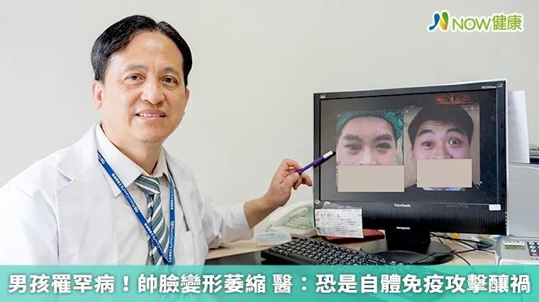 18歲男孩罹罕病！帥臉變形萎縮 醫：恐是自體免疫攻擊釀禍