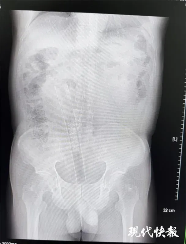 老翁「肛門插一根」痛到送急診　30公分塑膠管險致腸穿孔…原因超傻眼