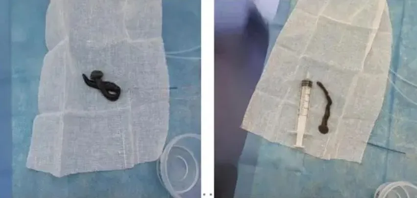 狂咳半月「痰中帶血絲」…氣管拉出8公分水蛭　醫生：或飲用生水所致