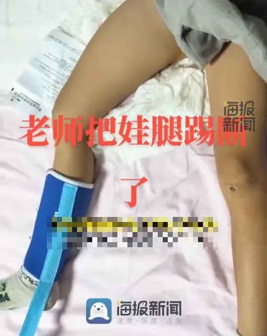 誇張！武術老師踢斷學生腿沒通知家長　偷送醫還「假扮親戚」簽診斷書