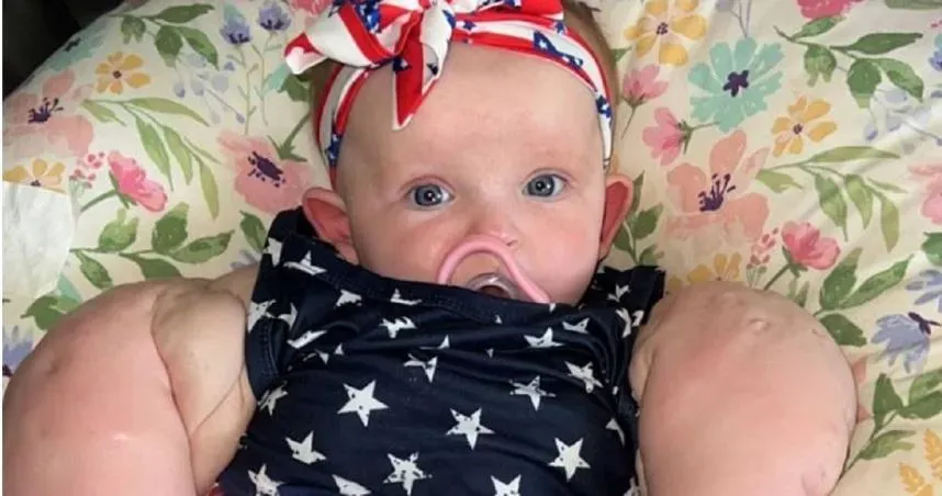 女嬰罹「先天疾病淋巴管瘤」媽知存活機率0拒墮胎！剖腹產5.4公斤巨寶寶