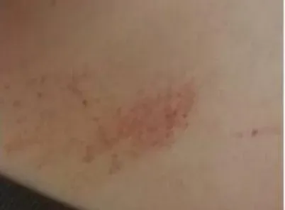 身體突冒大量紅點瘀青　女大生堅持旅遊…回程才就醫「被下病危通知