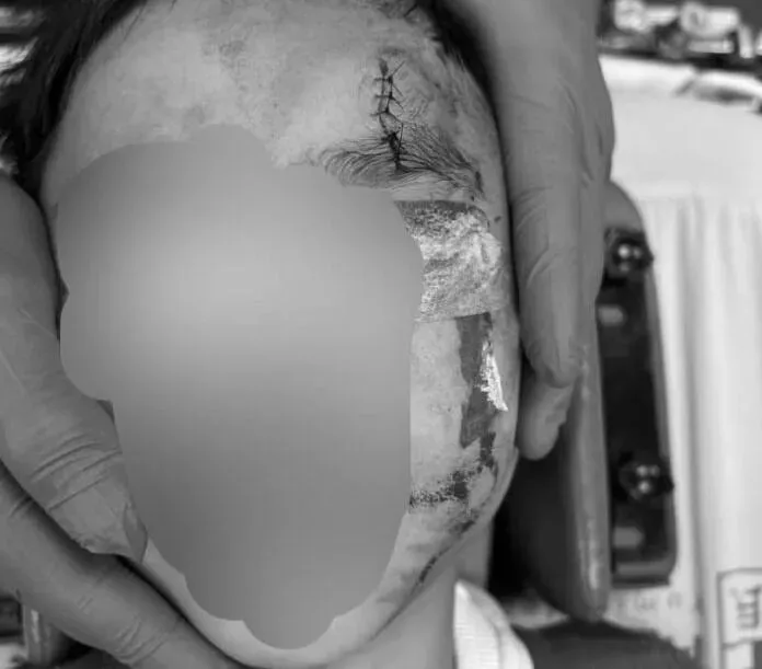 南投兒童公園磁磚剝落成利器！　小朋友撞到頭破血流縫6針急救