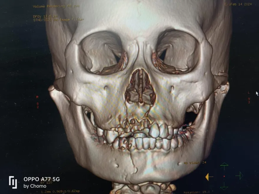 警世骷顱照！13歲少女半夜偷騎車「自撞電桿」　顏面摔碎得拼圖