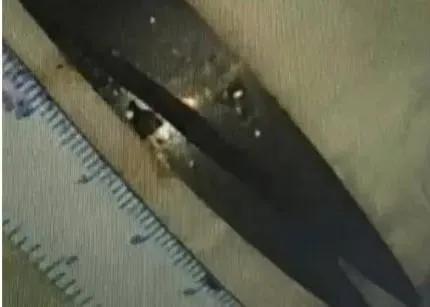 真D茫！酒醉狂吞剪刀＋3打火機　清醒衝醫院手術