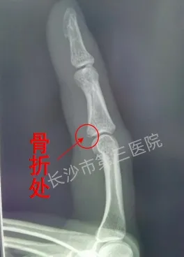 啪！女子一巴掌打蚊子「手指腫脹疼痛」　到醫院檢查竟「骨折了」