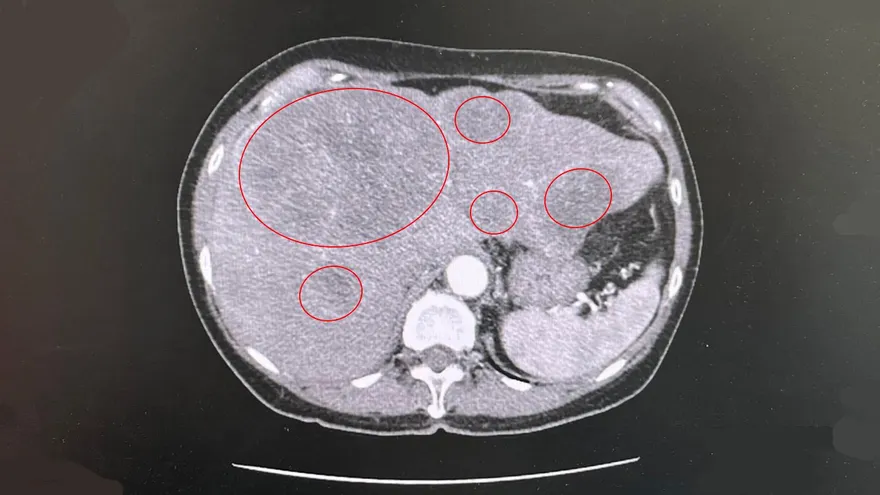 肛門出血當痔瘡！台中婦肝臟一照「一堆腫瘤」　直腸癌轉移