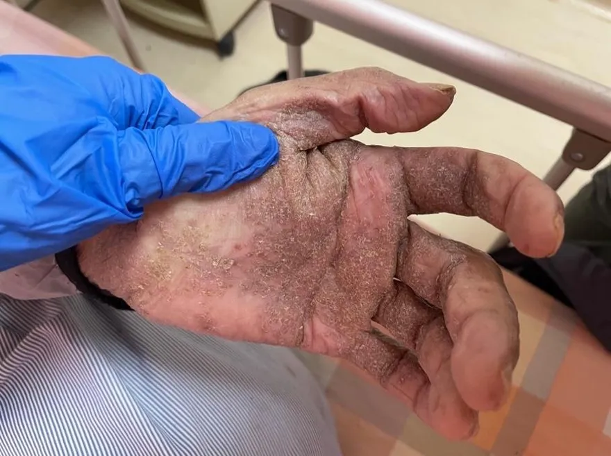 翁全身癢3個月抹濕疹藥膏好不了　竟是結痂型疥瘡作祟