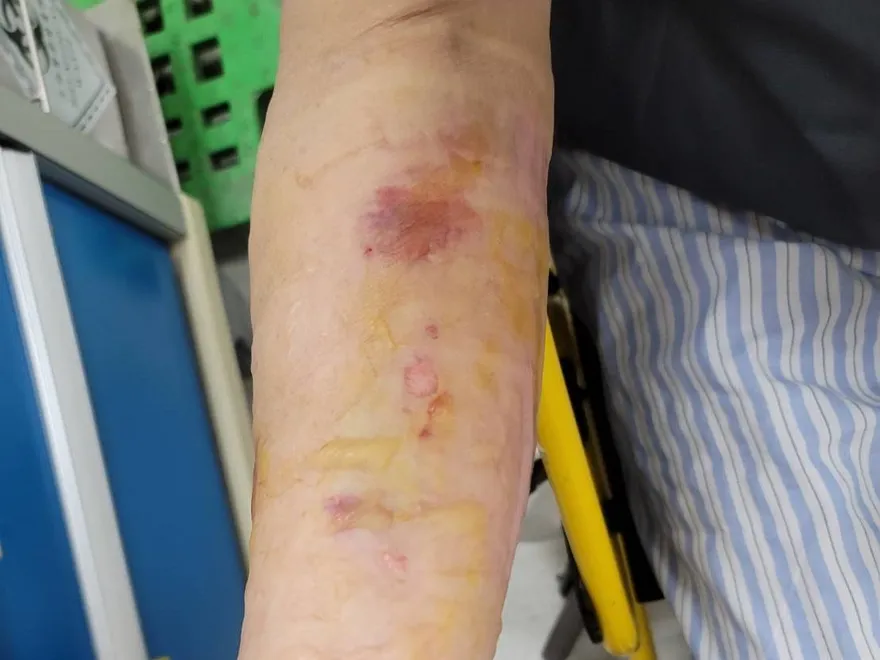 蚊子叮完塗大蒜？婦過敏細菌感染潰瘍　險釀蜂窩性組織炎