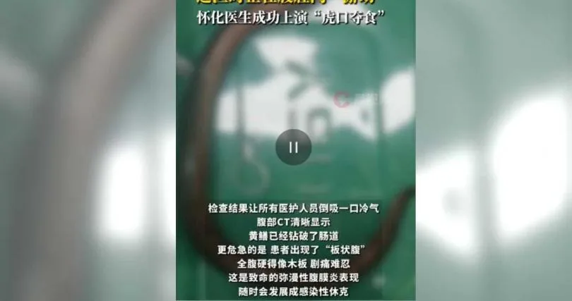 玩好大？　陸30歲男腸內驚見30公分黃鱔