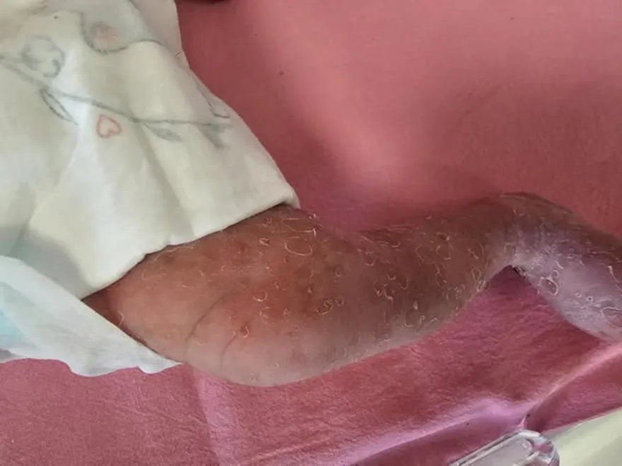 4萬分之1機率！新生女嬰全身紅疹　確診罕見色素失調症