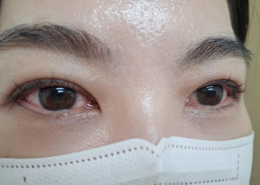眼睛紅腫恐是「急性結膜炎」醫：共用眼藥水易群聚感染