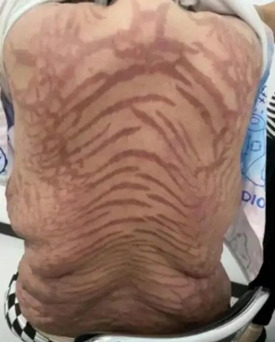 影/嚇人！網購藥膏塗10年　陸女腎上腺異常全身長滿蛇紋